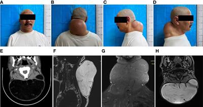 Case report: a case report of excision of giant lipoma in the posterior neck